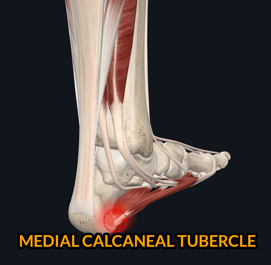 Medial Calcaneal Tubercle Pain