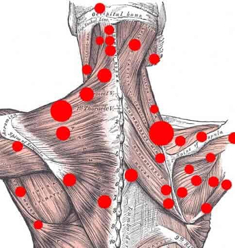 Trigger Points or Muscle Knots